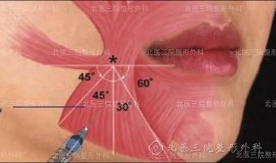 注射示意图对于该患者,我们医生为其进行了右侧降口角肌及降下唇肌