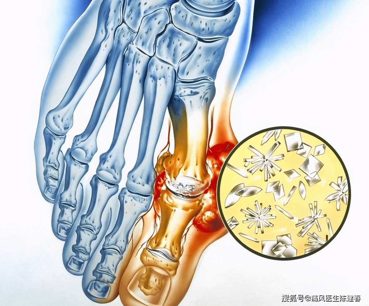痛风性关节炎好发部位为四肢小关节,尤其是第一跖趾关节,大部分患者第