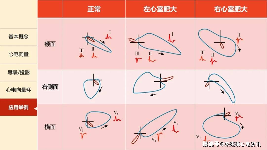 一文掌握心电向量:从基本原理到临床应用_电轴