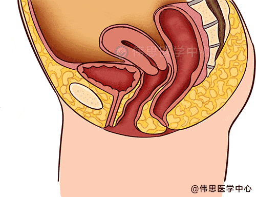 膨出的膀胱影响到尿道,导致患者在咳嗽或运动时