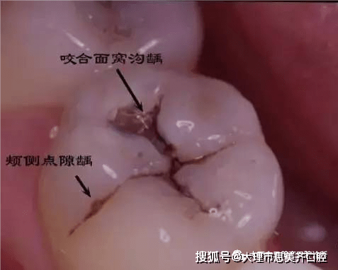 牙齿上小黑点的可怕力量_口腔