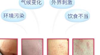 什么是特应性皮炎发病原因 d2acda8dbddb417b9265b79d2ad7c0aa.jpeg