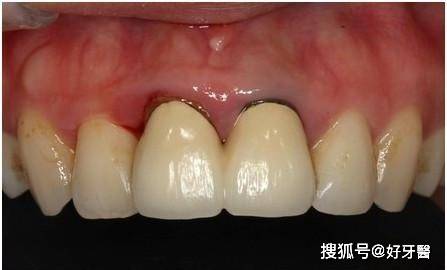 常见烤瓷牙变黑的原因有以下几个: 1,牙龈萎缩 牙龈萎缩会让烤瓷牙冠