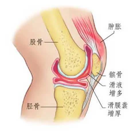 什么是滑膜炎以及症状 029d9602f9ce41858a18948f5d70df01.jpeg