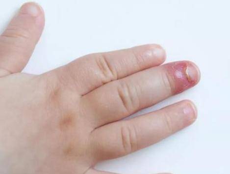 手痒爱抠的话就容易让皮肤破损,细菌侵入伤口,最后让手指发炎红肿