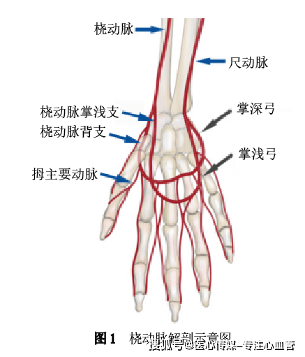 经远端桡动脉行冠状动脉介入诊疗中国专家共识