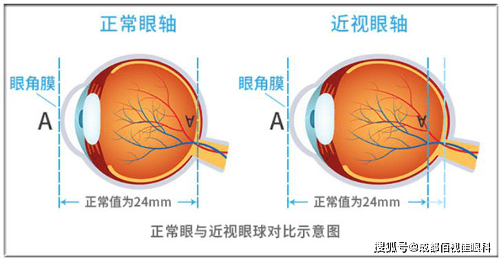 近视度数高到底有什么危害佰视佳眼科说