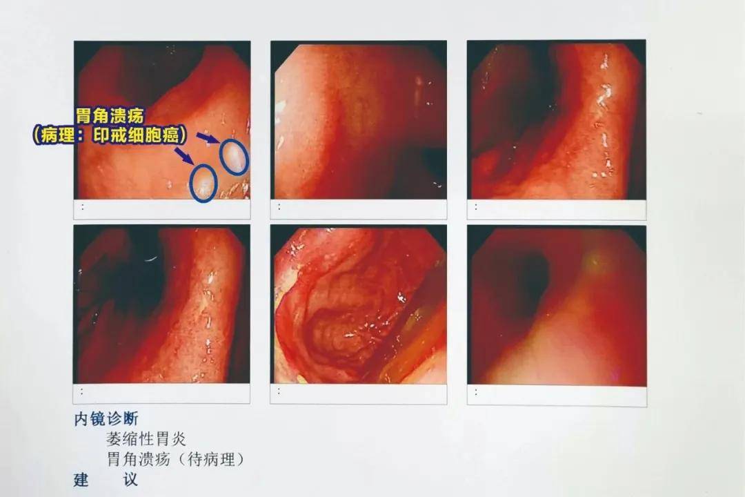 原创医生感染了幽门螺杆菌但没有症状需要治疗吗会不会患癌