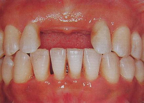 牙齿缺失影响全身健康,千万不能忽视!特别是老年人!