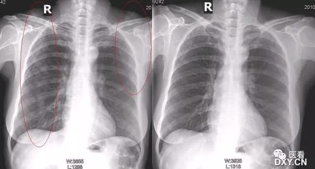 6例胸片假象分析,作为影像医生,总结一点经验教训!