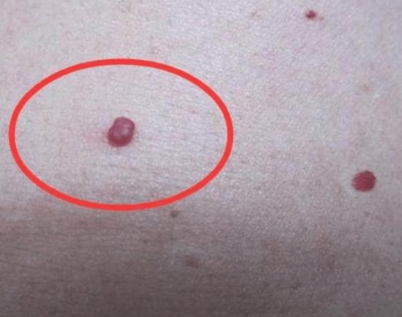 女性身上这1处长"小红点",或是hpv,建议定期检查身体