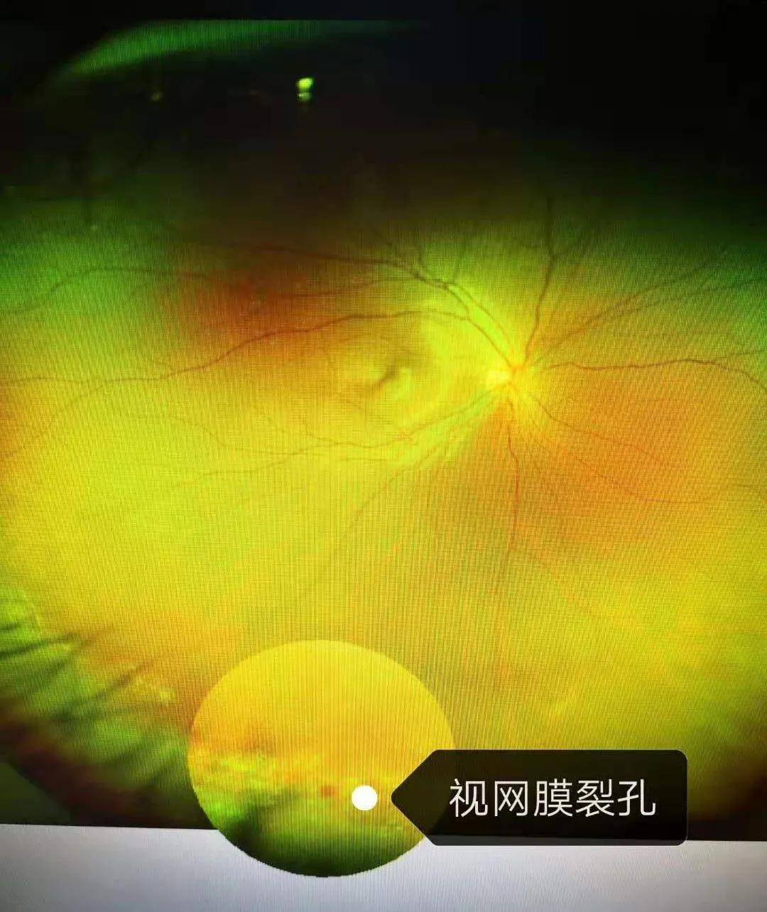 在做近视手术前的常规眼底检查时发现视网膜出现视网膜裂孔及变性带