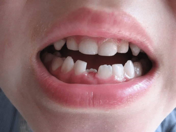 孩子换牙后的门牙变大板牙为什么呢