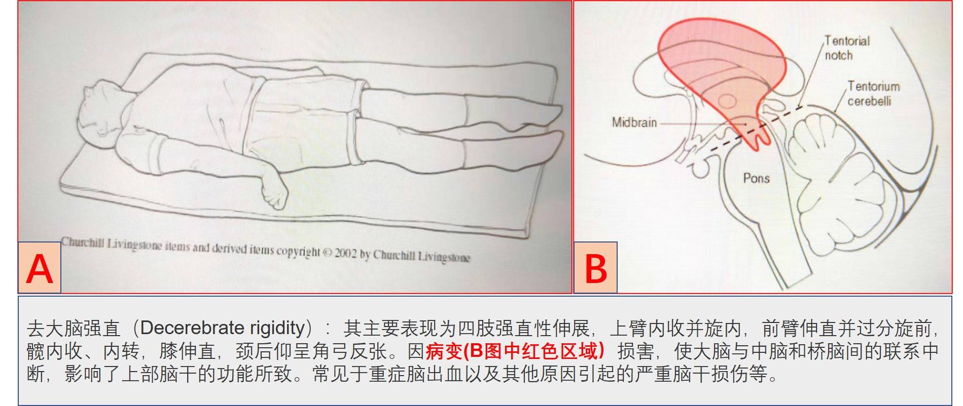 图2中的红色区域损伤就会导致去大脑强直,在临床中是一种严重的脑损伤