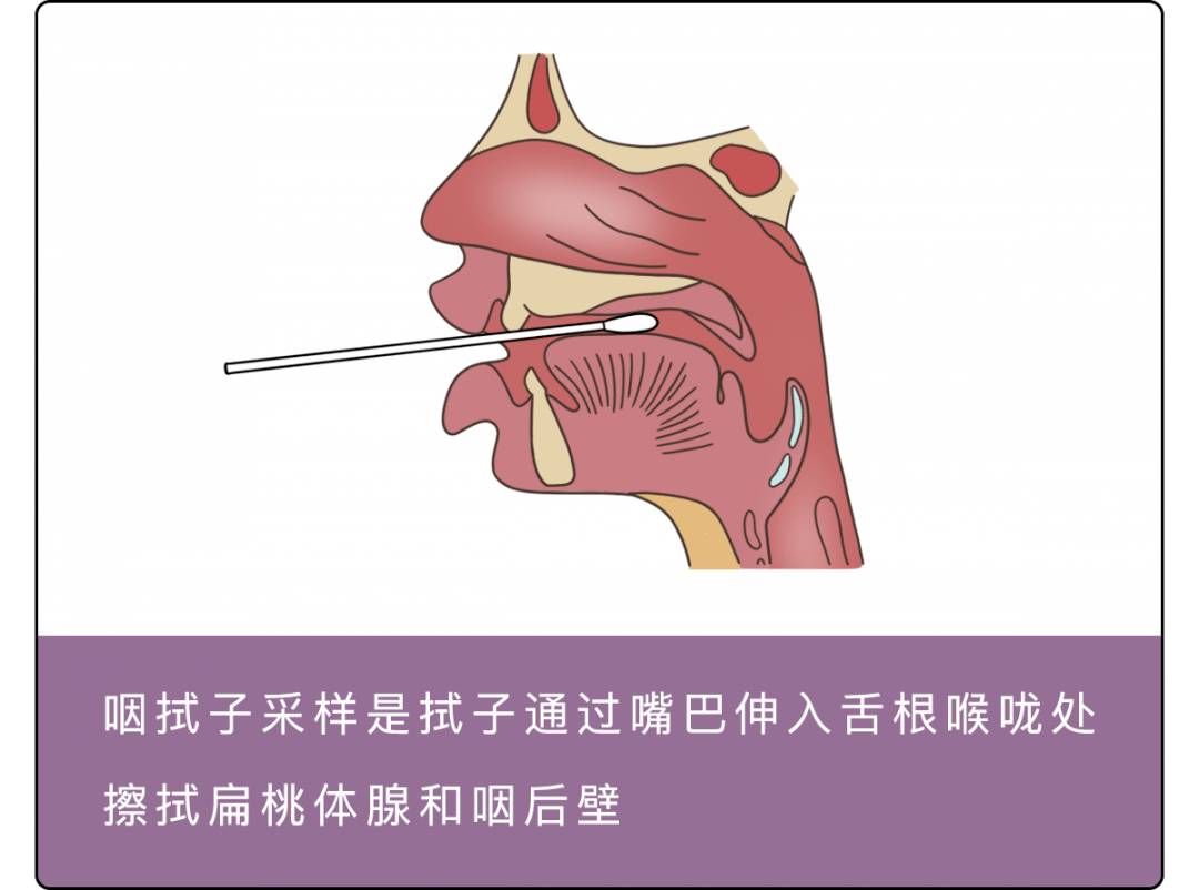 一定要提前告知医生 医生会采取合适的检测方案 另外 鼻咽拭子采集后