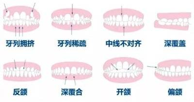 儿童咬合诱导对龅牙前突管用吗?