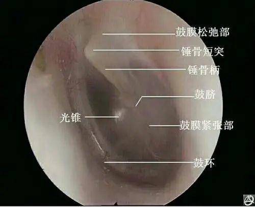 北碚惠耳听力:我的鼓膜穿孔了,需要立即手术修补吗?