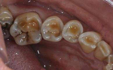 常伴有牙本质敏感和牙龈退缩等症状,严重者也可出现牙髓暴露甚至引起