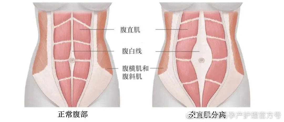 为什么你产后坚持做卷腹,肚子却越练越下垂?