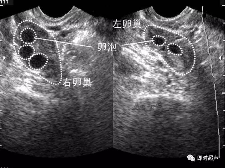 图2-1-12 卵巢声像图(经腹扫查)