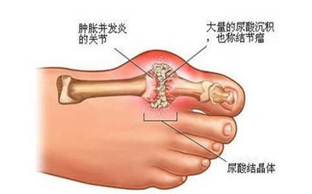 什么是痛风痛风是什么原因引起的