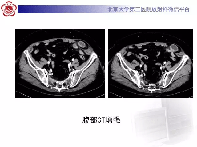 急诊你一定要知道的"半月线疝"