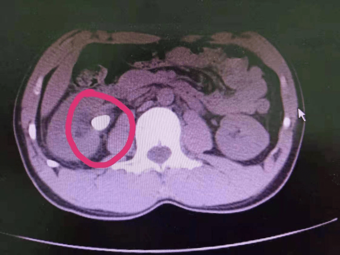 输尿管上段结石1.6cm,经皮肾镜术后未留置肾造瘘管