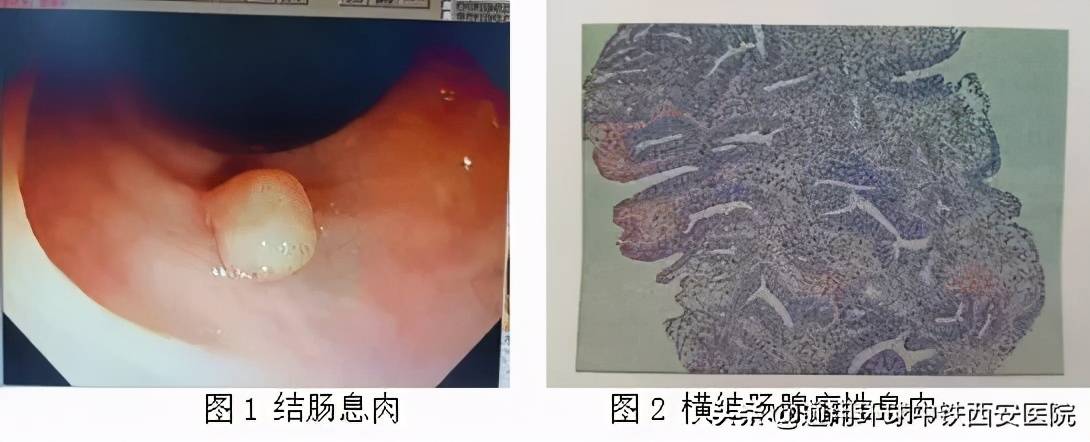 1.腺瘤样息肉(图1和图2),包括乳头状腺瘤,最常见