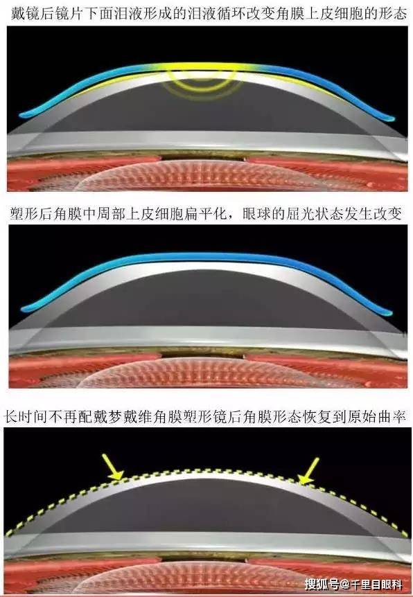 角膜塑形镜的作用原理是什么为啥这么神奇