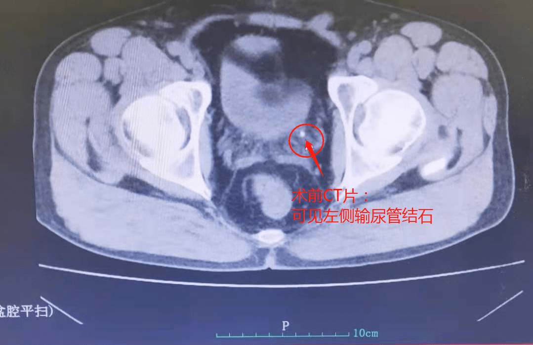 患者术前ct片:可见左侧输尿管结石影
