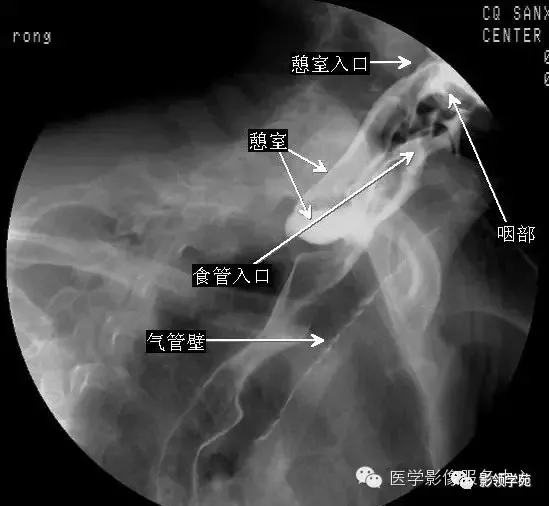 10种食管钡餐常见疾病图解