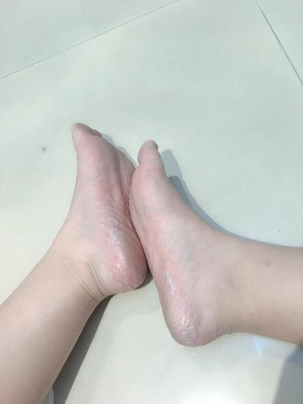 39岁,脚跟总有死皮,还裂了好多口子,该怎么办?
