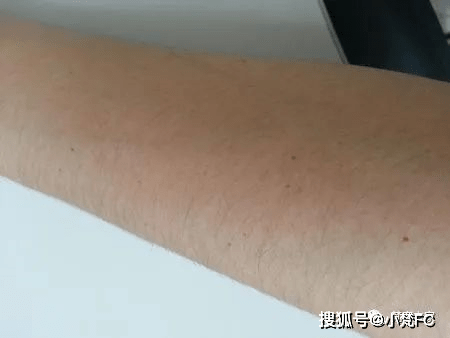【皮肤管理】手臂上有红点是怎么回事?