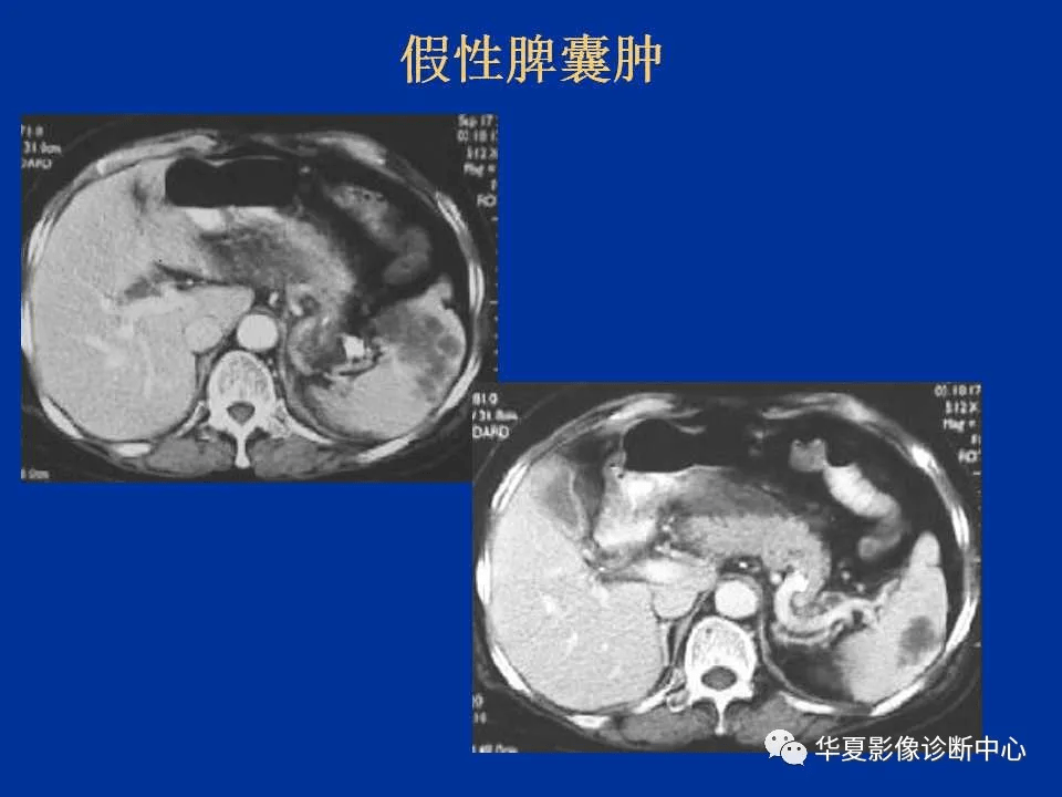 脾脏疾病的ct诊断