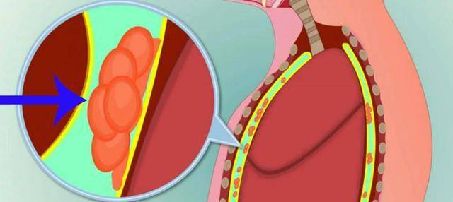 脏胸膜是没有痛觉神经的,而壁胸膜则含有痛觉神经.