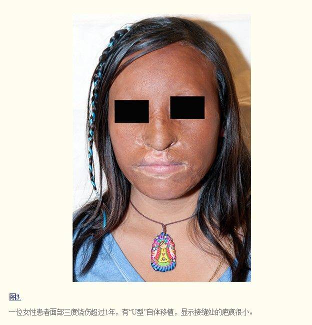 面部烧伤的处理 2 身材总监烧烫伤弹力衣定制