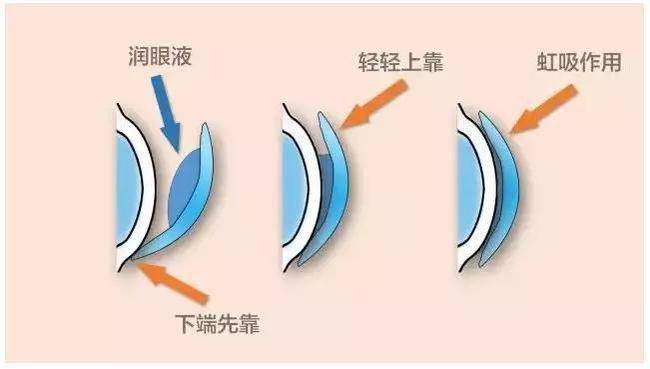 角膜塑形镜26问回答全部问题