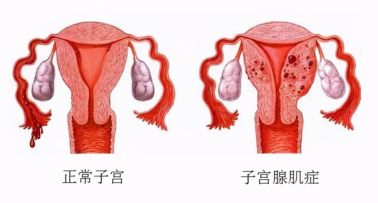 内膜异位于子宫肌层内,在激素的影响下发生出血,肌纤维结缔组织增生