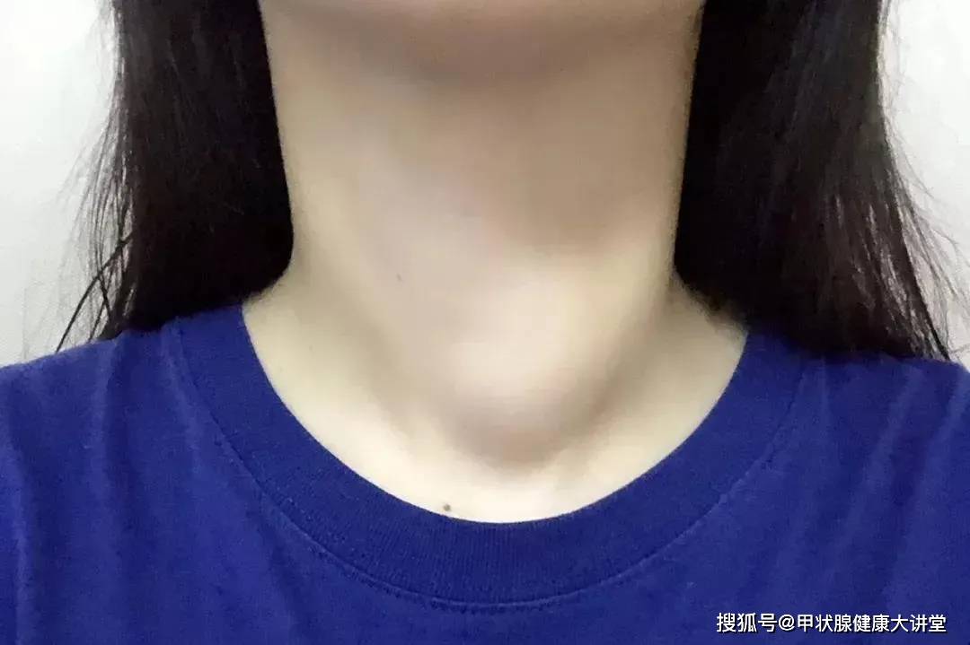 具体如下: ①甲状腺肿大:甲状腺肿大也就是脖子肿大,这是甲亢的典型