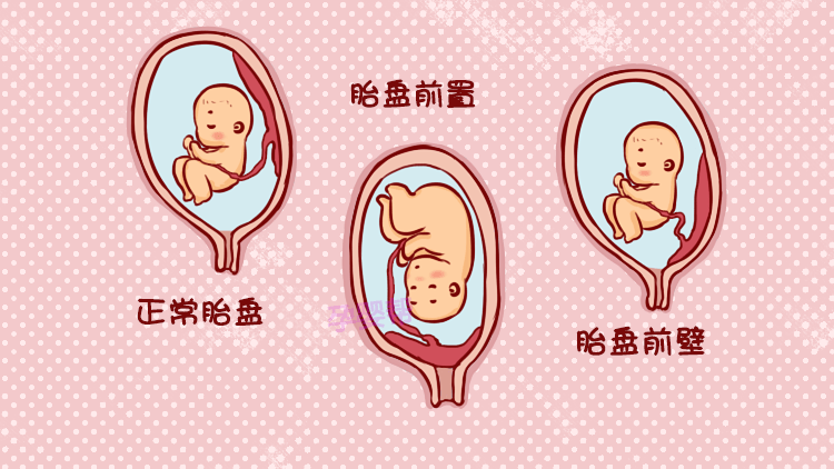 原创孕期身体出现这种情况,多半是胎盘低置,这3方面准妈妈要注意