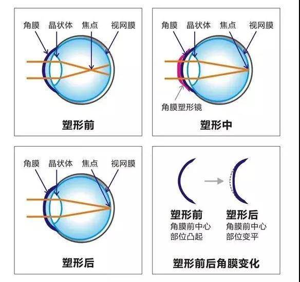 更推荐戴角膜接触镜,因为只有在角膜位置或眼内位置来矫正屈光参差,在
