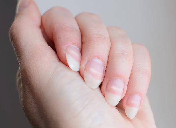 指甲有竖纹是疾病的信号关于指甲的真实情况不妨看看