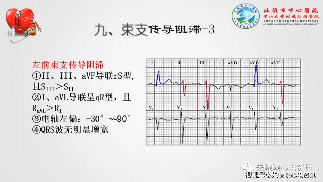 心电图要点知识汇总(ppt)