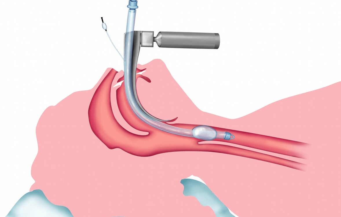 原创管子越多疾病越重气管插管这3个关键环节不可漏不可错