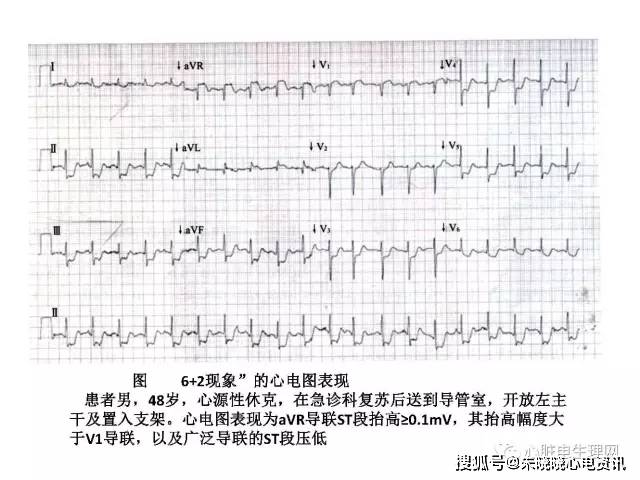 左主干病变心电图