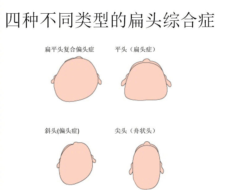 所谓扁平头综合症,就是长期保持一侧睡眠姿势,或是单纯保持交替睡眠