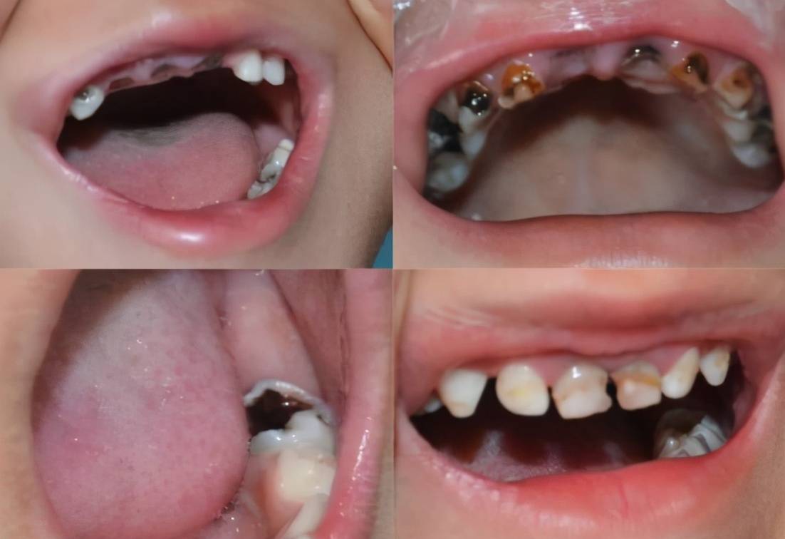 孩子满嘴"小黑牙,与经常吃糖无关,多半是父母无知造成的_牙齿