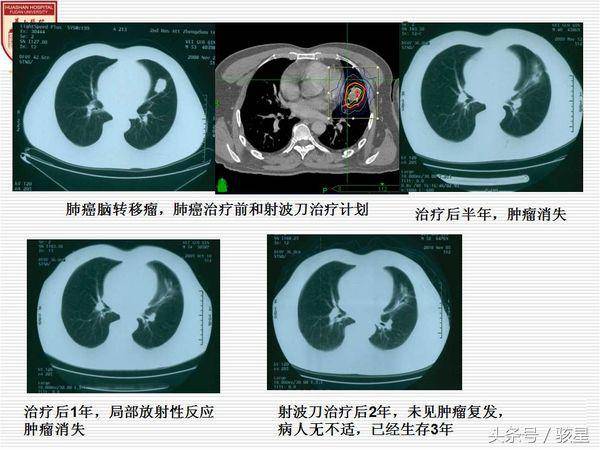 1月后病人病情稳定,穿刺活检证实是小细胞肺癌