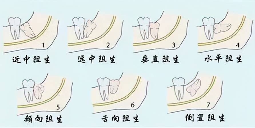 大部分智齿生长位置不正,容易出现紧靠第二磨牙,或是牙间空隙过大等