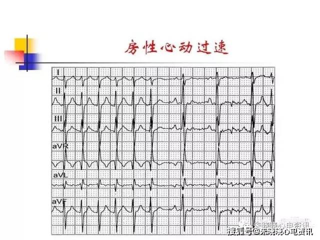 房速与房扑相关的心电问题